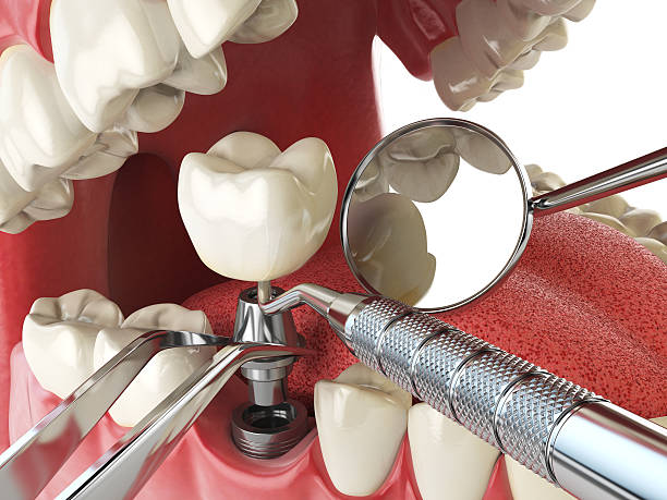 Best Dentist for Tooth Abscess  in Englewood, OH